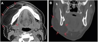 Tomografía Computada (TC) con medio de contraste. Cortes
axial (A) y coronal (B) de cabeza y cuello donde se observan límites y
extensión de la lesión tumoral (flechas)