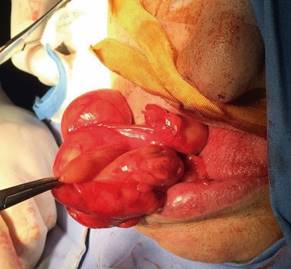 Imagen intraoperatoria de la exéresis de la lesión tumoral