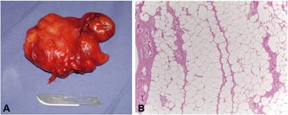 A. Muestra de tejido biopsiado B. Microfotografía de corte
histológico tinción hemotoxilina-eosina x200. Se observa tejido adiposo
adyacente a manojos de fibras colágenas, con algo de hialinización,
pequeños capilares. Presencia de abundantes adipocitos de aspecto
normal, separados por tabiques conjuntivales y pequeños capilares