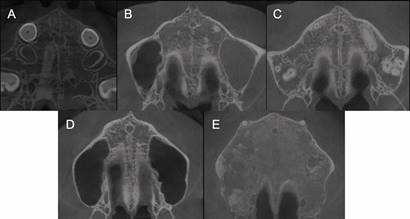 Etapas de maduración esqueletal de la sutura palatina media evaluadas. A, La sutura es visualizada como una línea hiperdensa relativamente recta, etapa A; B, la sutura aparece como una línea festoneada de alta densidad, etapa B; C, dos líneas hiperdensas paralelas, festoneadas separadas por áreas de baja densidad, etapa C; D, los huesos palatinos se observan más hiperdensos y la sutura no puede ser visualizada en esta región, etapa D; E, no es posible visualizar la sutura a lo largo de los huesos maxilares y palatinos, etapa E.
