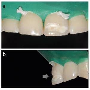 Fotografía clínica de defecto de esmalte en 2.1 de mancha blanca y amarilla por vestibular (a), en imagen lateral se observa defecto en grosor del esmalte (b).