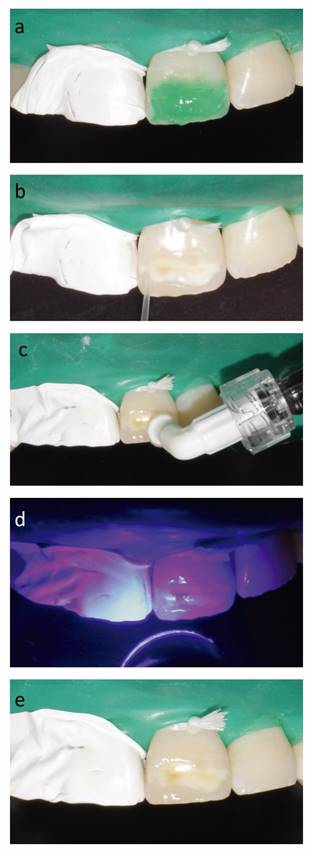 Secuencia clínica de procedimiento de infiltración del defecto de esmalte. Grabado de la lesión con ácido clorhídrico (a), secado con solución de etanol (b), infiltración (c), fotopolimerización (d), post-infiltración (e).