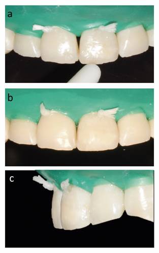 Secuencia clínica de restauración directa con resina compuesta.