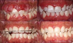Clinical aspect of the case: (a) before treatment, (b) 12 months, (c) 26 months and (d) 48 months after treatment.