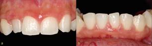 A 48-months periodontal follow-up (a) Maxillary view. (b) Approximate mandibular aspect.