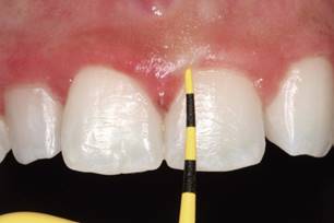 Periodontal probing at 48-month follow-up.