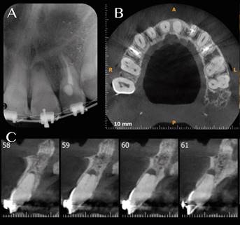 A Radiograf&iacute;a Inicial, B Vision axial TCHC y C Vison Sagital TCHC.