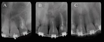 A Rx previa, B Rx control obturaci&oacute;n, 1/3 apical sellado con Biodentine, radiopacidad similar a dentina y C Rx control 12 meses.