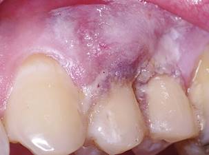 Envelope technique with an exposed connective tissue graft: The graft was inserted and leaved expose 2mm. The tissue adhesive was covering the flap and the graft stabilizing the area for 10 days.