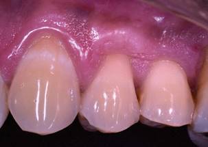 Result 5 years after the surgery: The margins are stable with PD of 1mm. and CAL of 1mm.