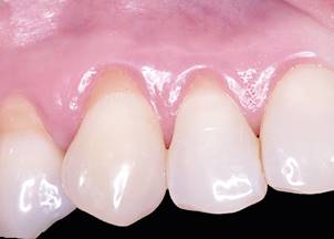 Baseline recessions: The recessions class RT1 of Cairo in 1.3 and 1.2 are 2mm. and 1mm. length, respectively. The phenotype was classified as thin.