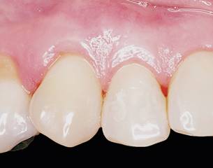 Result 5 years after the surgery: The margins are stable with PD of 1mm. and CAL of 1mm.