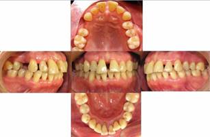 Fotografías intraorales iniciales. Se observa migración dentaria patológica en sextante 2 y 5 con formación de diastemas. Extrusión de diente 1.1