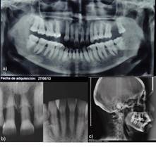 a) Radiografía panorámica al iniciar tratamiento ortodóncico. b) Radiografía retroalveolar dientes 1.1, 2.1 y sextante 5. c) Teleradiografía de perfil inicial