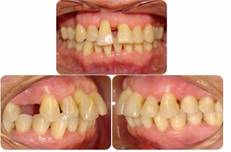 Tejidos periodontales durante TSP