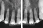 Radiografía retroalveolar sextante 2 a los 13 meses de tratamiento
