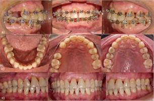 a) 16 meses de tratamiento. b) Contención lingual y palatina c) Tratamiento ortodóncico finalizado. Implante dental diente 1.4