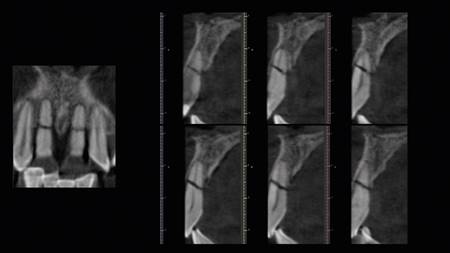 Se confirmaron fracturas asintomáticas de ambos incisivos centrales superiores en el tercio medio radicular, con leve desplazamiento coronal y movilidad clase II