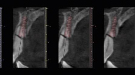 Utilizando el software BlueSky plan, se planificaron dos implantes cónicos separados de la parte vestibular de las raíces.