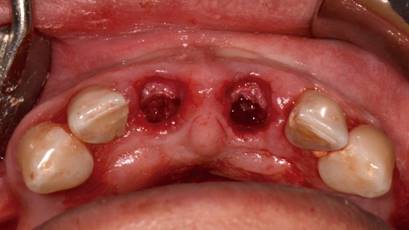 Se retiró la parte palatina y se conservaron 5 mm de la pared vestibular radicular.