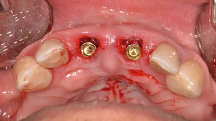 Ambos implantes alcanzaron 40 N de torque, todo bajo un protocolo de cirugía e inserción guiada estricta de implantes.