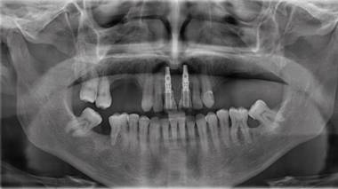 Radiografía panorámica de control post operatorio (21 días después)