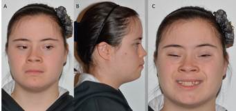 Fotografías Extraorales. A, Fotografía frontal. B, Fotografía lateral. C, Fotografía de sonrisa.