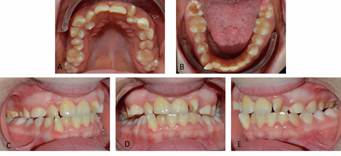A, Fotografía oclusal del arco superior, apiñamiento severo con rotación de molares, diente 1.5 mesioversión, dientes 1.3 y 2.3 erupcionados por palatino. B, Fotografía oclusal del arco inferior con apiñamiento severo, 4.7 caries oclusal, Fibroma irritativo cubriendo cara oclusal de 3.7. C, Fotografía lateral de oclusión lado derecho. D, Fotografía frontal de arcadas en oclusión. E, Fotografía lateral de oclusión lado izquierdo, mordida cruzada entre dientes 2.6- 3.6 y 2.5- 3.5.