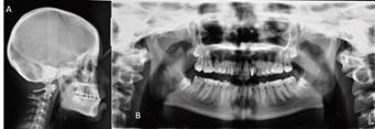 A, Telerradiografía de perfil inicial, paciente presenta acomodación mandibular presentando mordida invertida, lo que no se observa clínicamente. No permitió repetición de la radiografía. B, Ortopantomografía inicial.