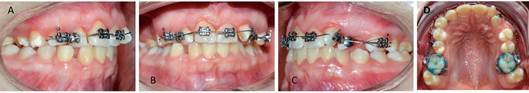 Instalación de multibrackets en forma parcial para adaptación para realizar adaptación sensorial. A, visión derecha. B, visión frontal. C, visión izquierda. D, Luego de 4 meses se logra instalar la arcada completa, con algunos desalojos de brackets entre sesiones.