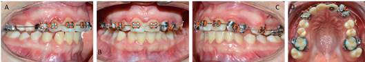 Instalación de bandas en piezas 1.3 y 2.2, botones en piezas 2.1, 2.2, 2.3 por palatino. Paciente llega con múltiples desalojos y gingivitis generalizada, por lo que fue derivada a periodoncista. A, visión derecha. B, visión frontal. C, visión izquierda. D, arco superior.