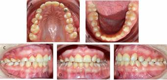 Control 6 meses. Se observa diastema entre piezas 2.2-2.3. A, Arco superior. B, arco inferior. C, oclusión visión derecha. D, oclusión visión frontal. E, oclusión visión izquierda.