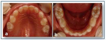 Caries temprana de la infancia en un paciente de 5 años de edad. a: Vista intraoral del maxilar superior, se observa caries en incisivos y molares primarios; b: Vista intraoral del maxilar inferior, se observa caries en molares primarios.
