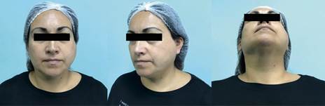 Fotografías extraorales iniciales: Aumento de volumen hemifacial izquierdo.