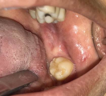 Fotografía intraoral inicial.