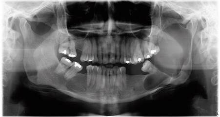 Radiografía panorámica inicial.