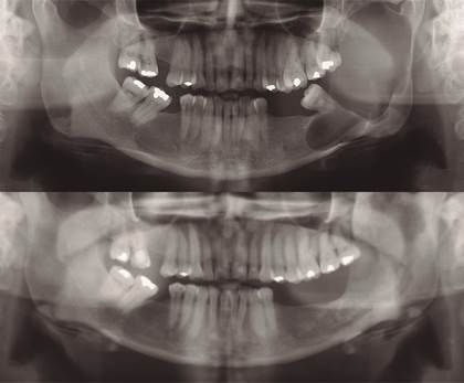 Radiografías panorámicas inicial y 11 meses postquirúrgica