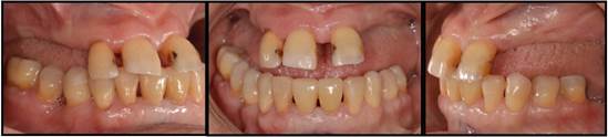 Vistas frontal y laterales finalizada la etapa de rehabilitación del plano mandibular.