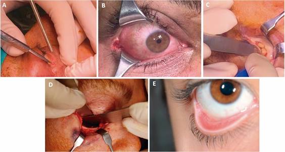 Técnica intraoperatoria de cantolisis lateral como complemento a acceso transconjuntival. A. Incisión del tarso con tijera iris. B. La cantolisis lateral es de espesor total e incluye plano cutáneo, tarso, músculo orbicular y conjuntiva palpebral. C. Acceso transconjuntival retroseptal. D. Exposición de reborde infraorbitario. E. Resultado clínico post operatorio de técnica.