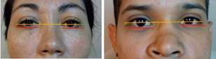 Pacientes con descenso del párpado inferior, asociado a acceso transconjuntival.