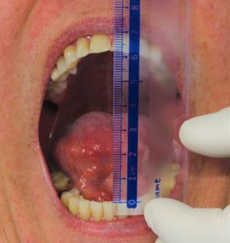 Registro de la apertura bucal del paciente mediante distancia interincisal
