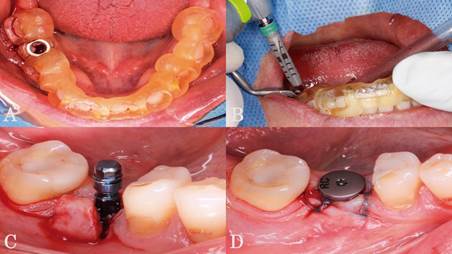 A: Guía quirúrgica estabilizada. B: Preparación del lecho receptor C: Implante dental colocado. D: Colocación de cicatrizal y suturas.
