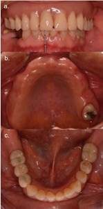 Imágenes iniciales del caso. Fig.1a: Fotografía frontal de relación intermaxilar. Prótesis total removible superior y antagonista con implantes oseintegrados, previo a rehabilitación. Fig.1b: Maxilar superior. Fig.1c: Mandíbula con rehabilitación PFP de 3 unidades sobre implantes 4.4 y 4.6 y PFU implantosoportada 3.6.