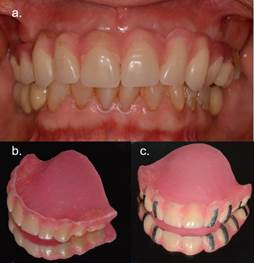 Fig.2a y 2b: Enfilado dentario en lámina fotopolimerizable sin flanco para prueba funcional y de parámetros estéticos. Fig.2c: Guía radiográfica. Enfilado dentario con marcadores radiopacos.