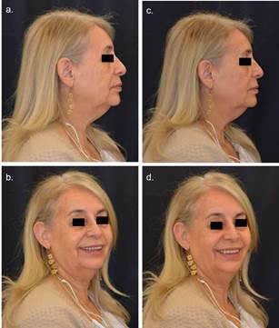 Prueba de perfil facial. Fig.3a y 3b (izq.): Paciente con su prótesis removible en vista lateral y 45 grados. Fig.3c y 3d (der.): Paciente con nuevo enfilado sin flanco, en vista frontal y 45 grados.