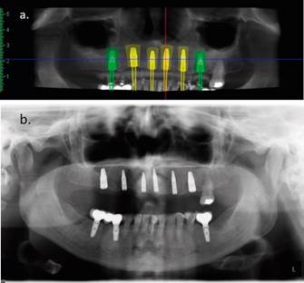 Fig.4a: Planificación digital (Romexis®). Fig.4b: Ortopantomografía de control inmediato postquirúrgico.