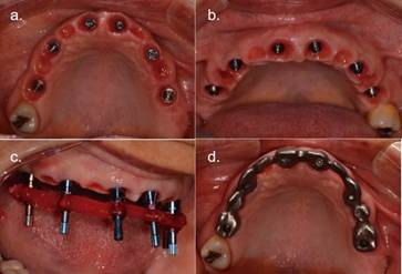 Fig.5a y b: Sculpting de mucosa peri-implantaria. Fig.5c: Ferulización con resina acrílica de pilares de transferencia previo a impresión. Fig.5d: Prueba de estructura metálica.