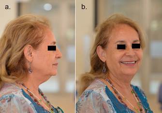 Fotografías finales de paciente con rehabilitación definitiva. Fig 7a: Perfil facial y soporte labial. Fig 7b: Fotografía en sonrisa.