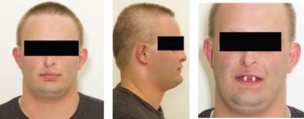 Patient at initial assessment. Extra-oral pictures showing aspects of disorder.