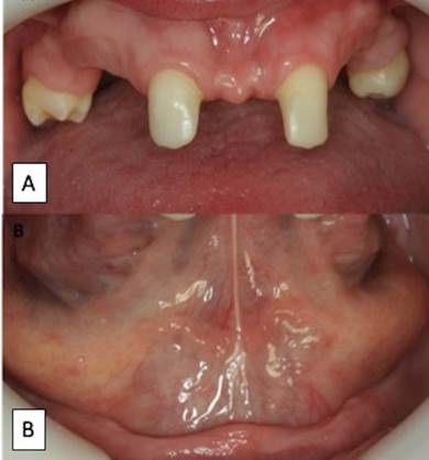 Clinical view of the patient (A: upper teeth and B: mandible)